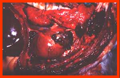 Right Atrial Hemangiosarcoma